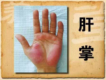 20120811养生堂视频王贵强讲脂肪肝高血脂呵护肝脏重在细节