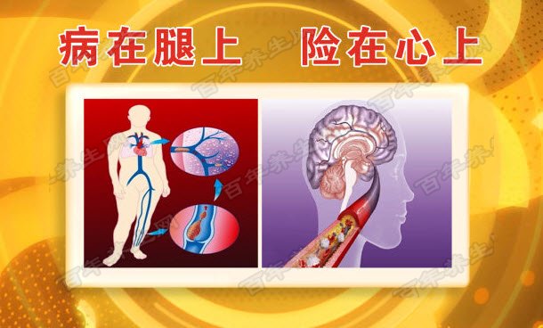 20160305养生堂视频和笔记刘鹏栓塞动脉栓塞间歇跛行静息痛